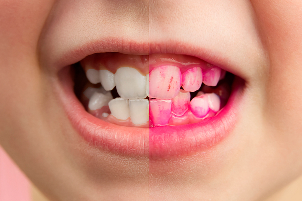 Зубной налет — как с ним бороться
